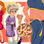 Osteoporosis